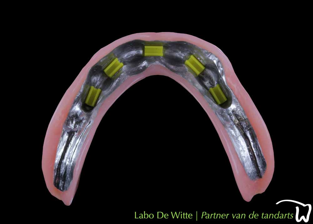 controleren klimaat slagader klikgebit op implantaten - Labo De Witte - partner van de tandarts